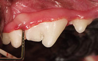 Periodontal disease